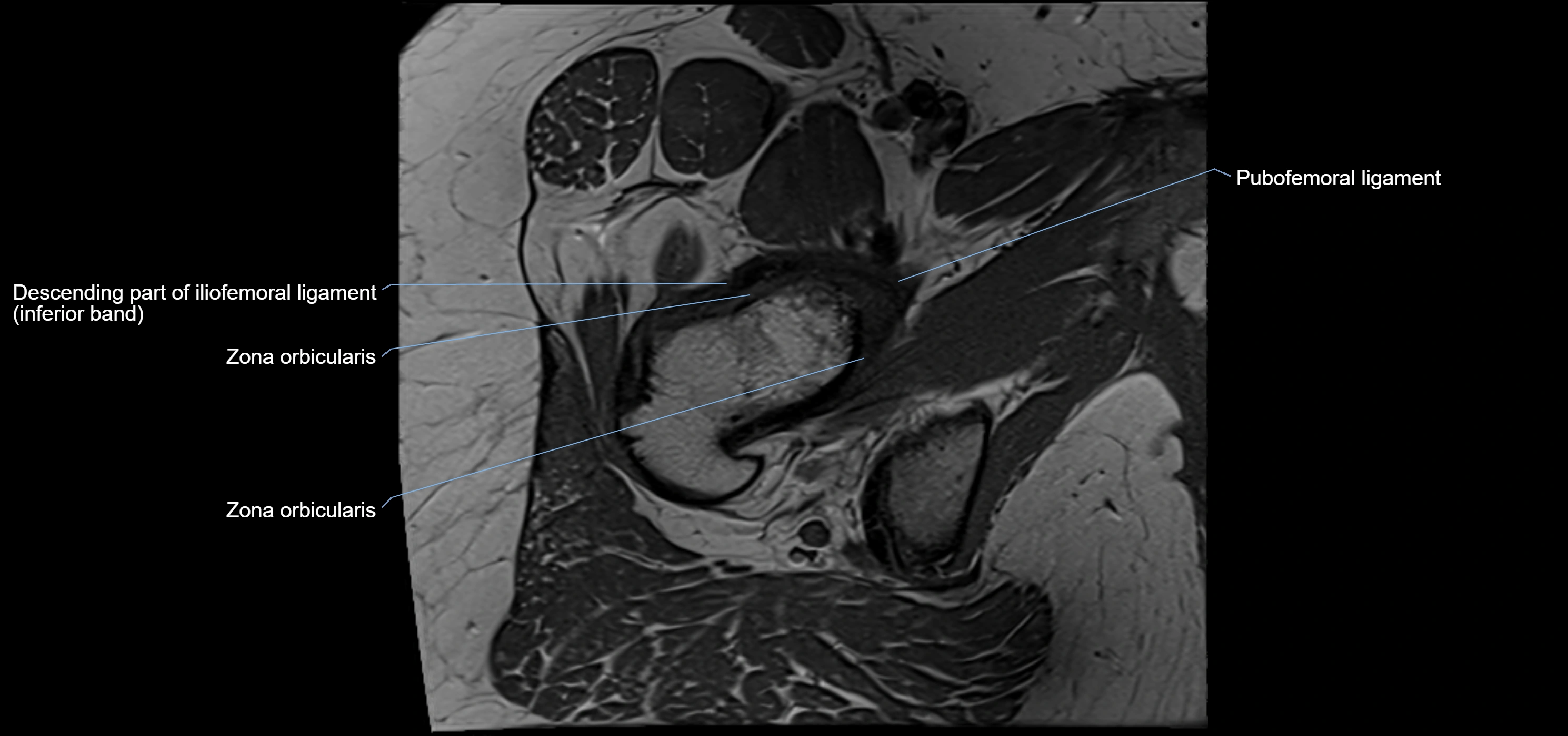 Hip ligament anatomy axial 3T MRI image -img-13001-00022.webp